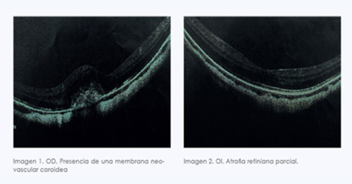 MIOPÍA PATOLÓGICA EVALUADA CON IMÁGENES DE OCT