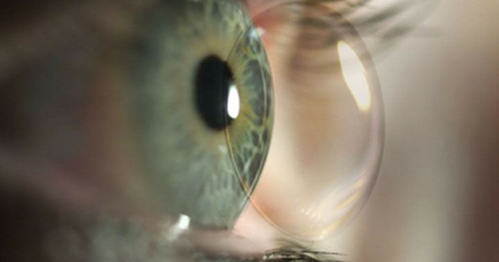 5 MÉTODOS PARA AYUDAR AL CUMPLIMIENTO DE LOS USUARIOS DE LENTES DE CONTACTO