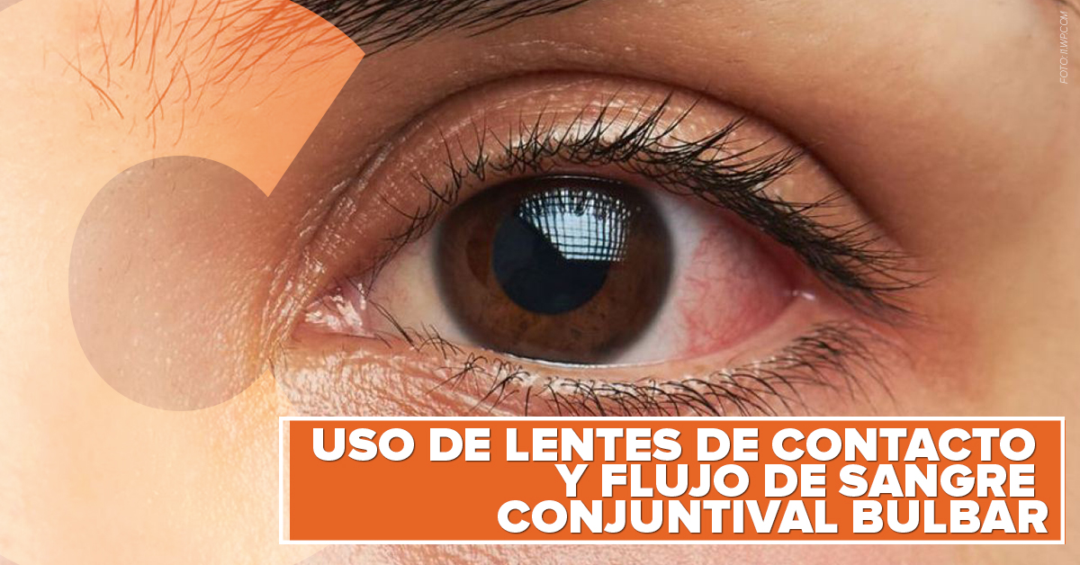 Uso de lentes de contacto y flujo sanguíneo conjuntival