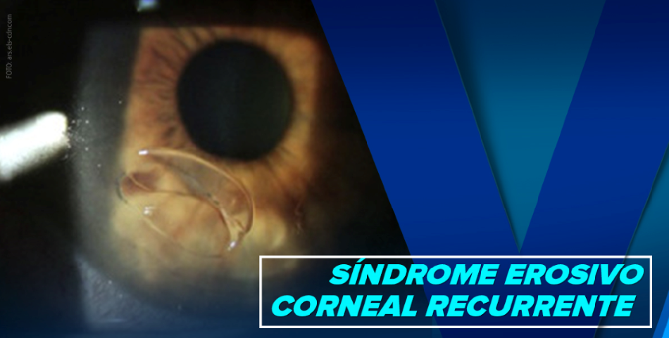 SÍNDROME EROSIVO CORNEAL RECURRENTE