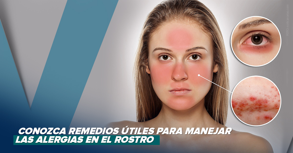Conozca remedios útiles para manejar las alergias en el rostro