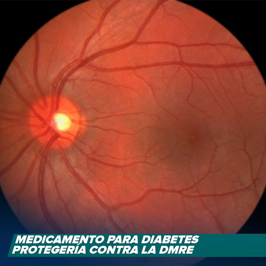 Medicamento para diabetes protegería contra la DMRE