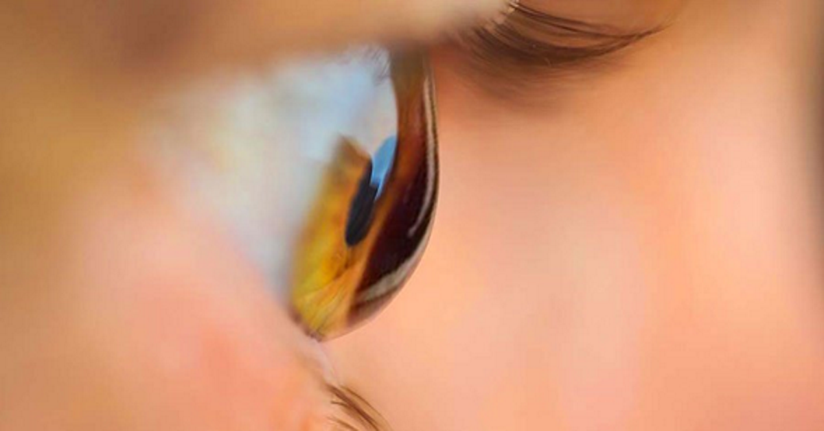 La progresión del queratocono