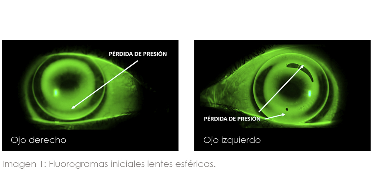 ORTOQUERATOLOGÍA EN CÓRNEAS TÓRICAS