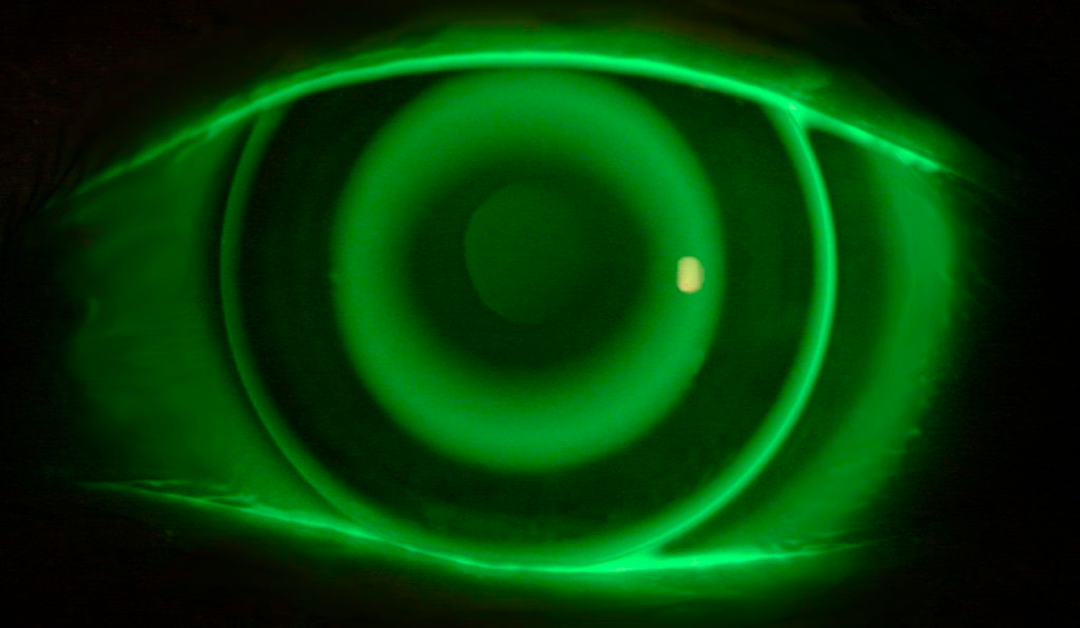 Ortoqueratología en anisometropía, Miópica