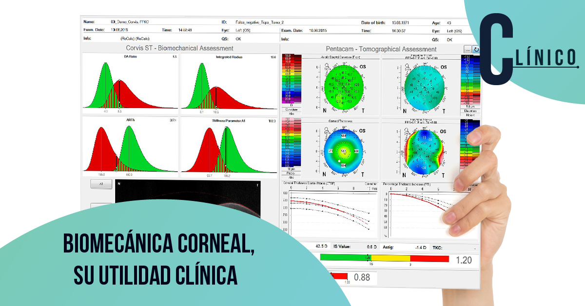 Biomecánica corneal, su utilidad clínica