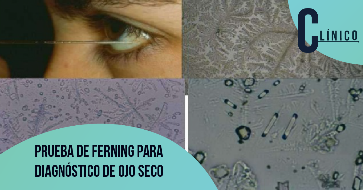 Prueba de Ferning para diagnóstico de ojo seco