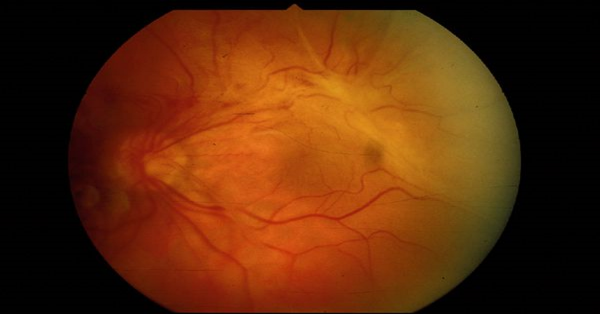 RETINOPATÍA POR RADIOTERAPIA