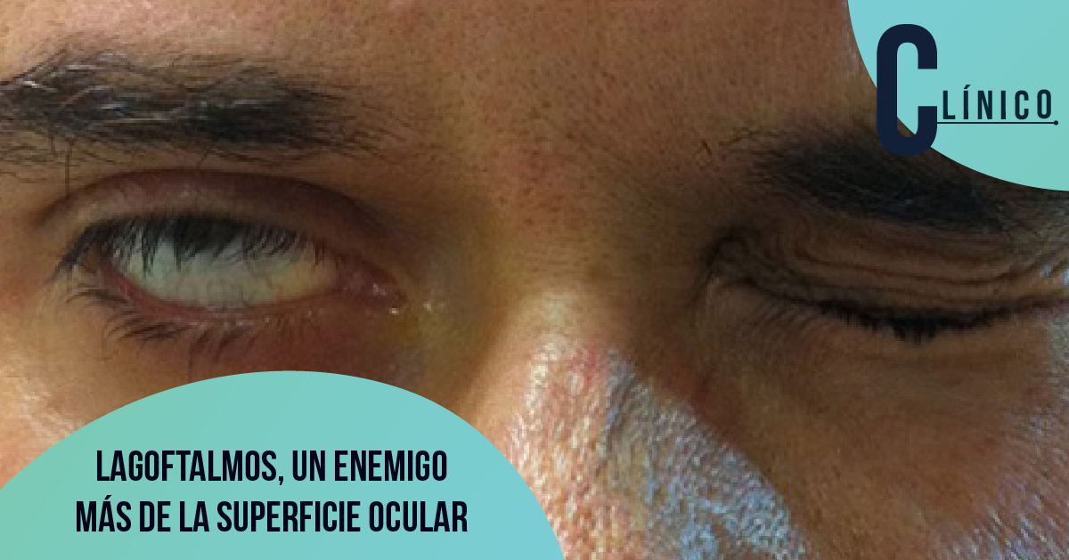 LAGOFTALMOS, UN ENEMIGO MÁS DE LA SUPERFICIE OCULAR