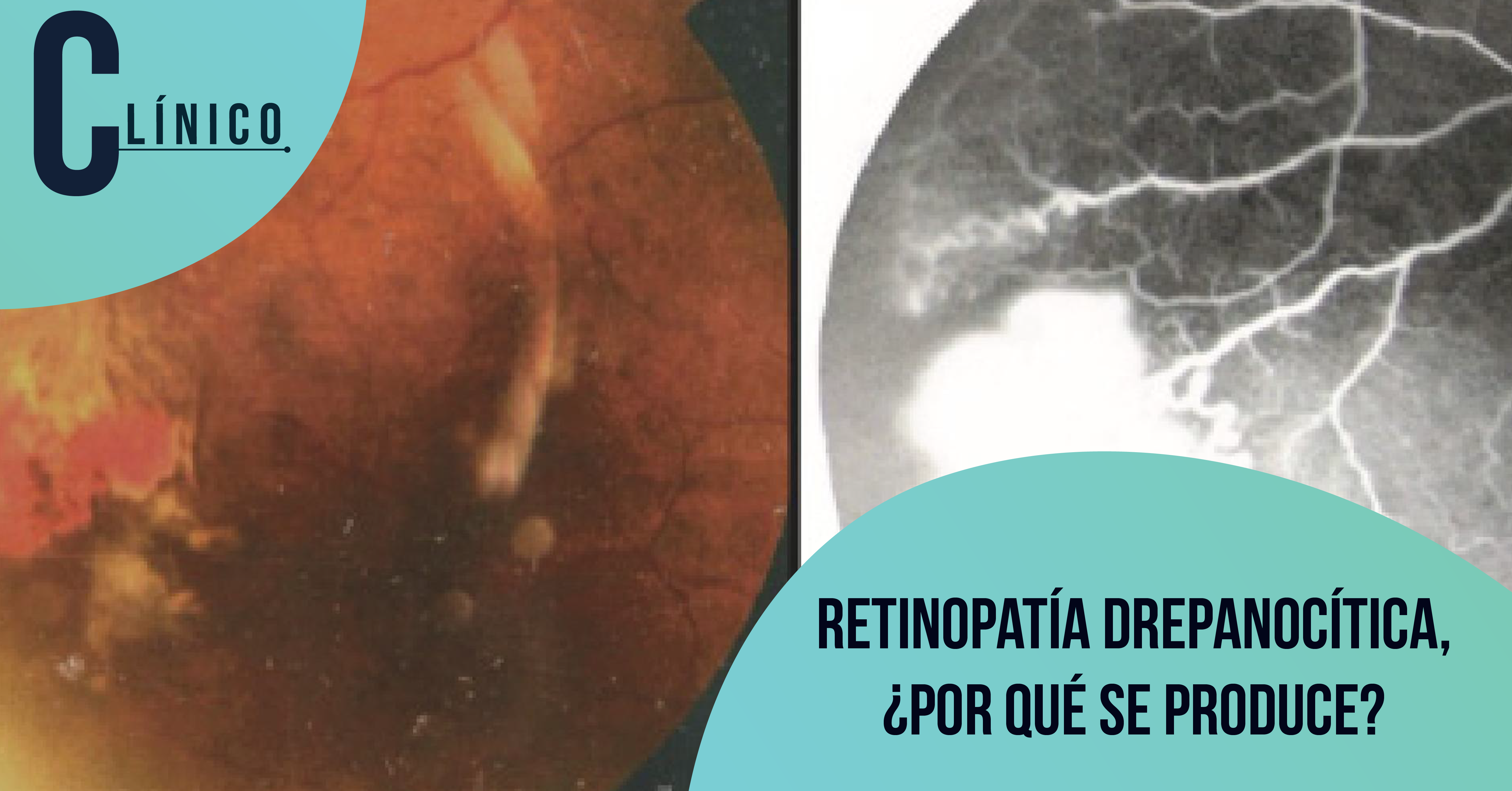 RETINOPATÍA DREPANOCÍTICA, ¿POR QUÉ SE PRODUCE?