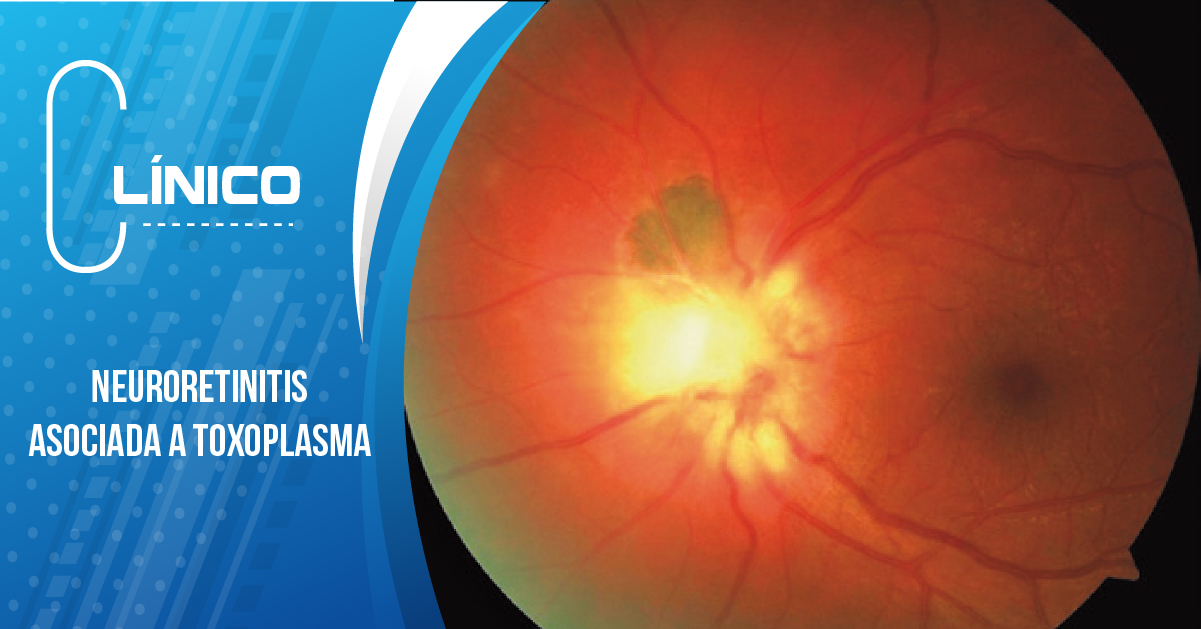 NEURORETINITIS ASOCIADA A TOXOPLASMA
