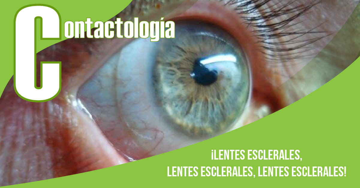 ¡LENTES ESCLERALES, LENTES ESCLERALES, LENTES ESCLERALES!