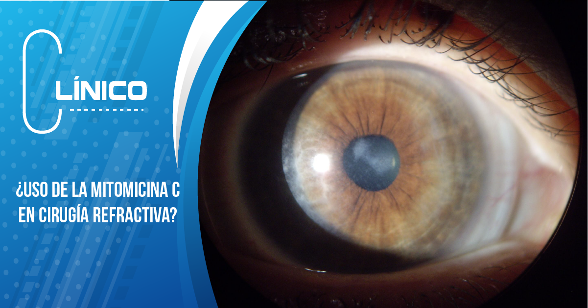 ¿USO DE LA MITOMICINA C EN CIRUGÍA REFRACTIVA?