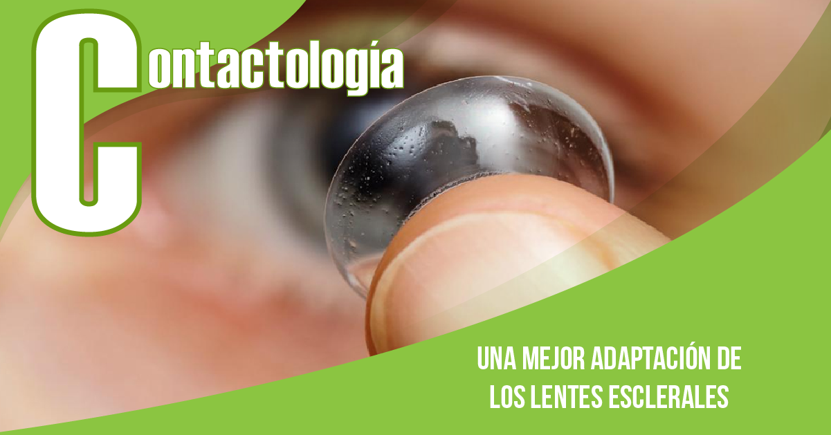 UNA MEJOR ADAPTACIÓN DE LENTES ESCLERALES