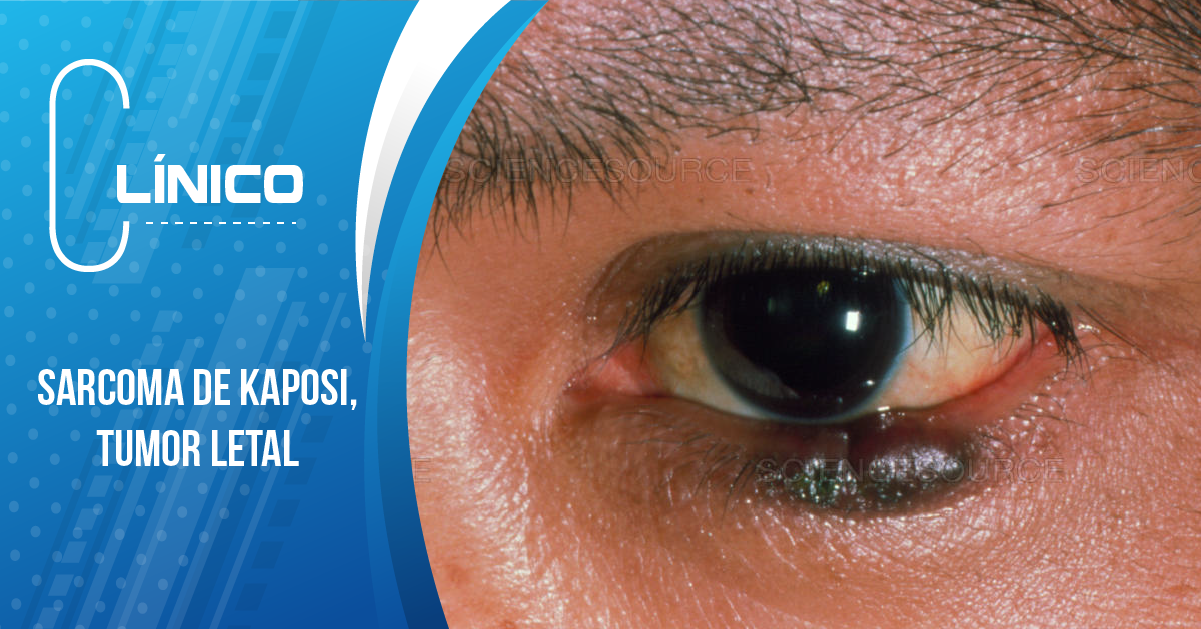 SARCOMA DE KAPOSI, TUMOR LETAL