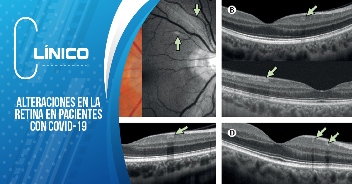 ALTERACIONES EN LA RETINA EN PACIENTES CON COVID-19