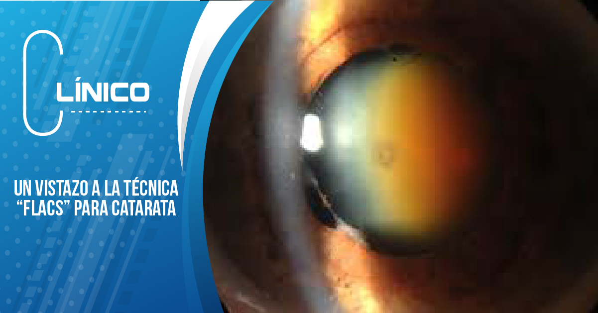 UN VISTAZO A LA TÉCNICA “FLACS” PARA CATARATA