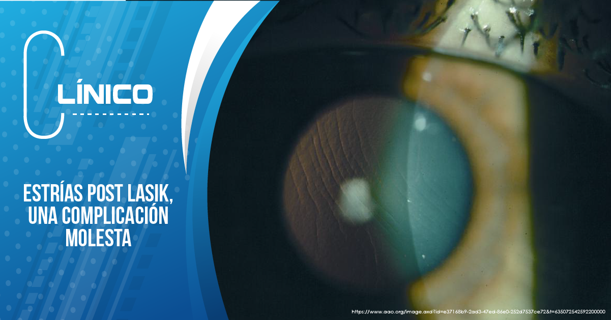 ESTRÍAS POST LASIK, UNA COMPLICACIÓN  MOLESTA