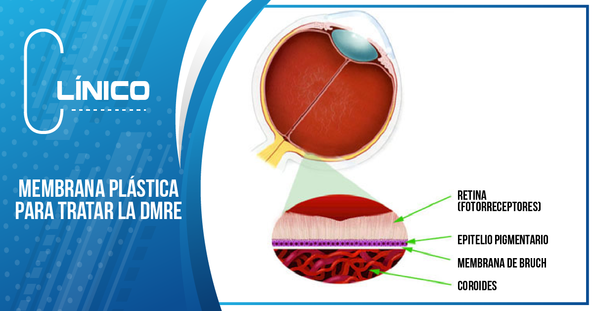 MEMBRANA PLÁSTICA PARA TRATAR LA DMRE