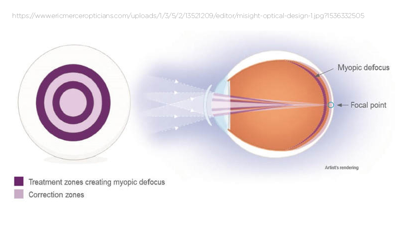 FDA APRUEBA PRIMER LC PARA EL CONTROL DE LA MIOPÍA
