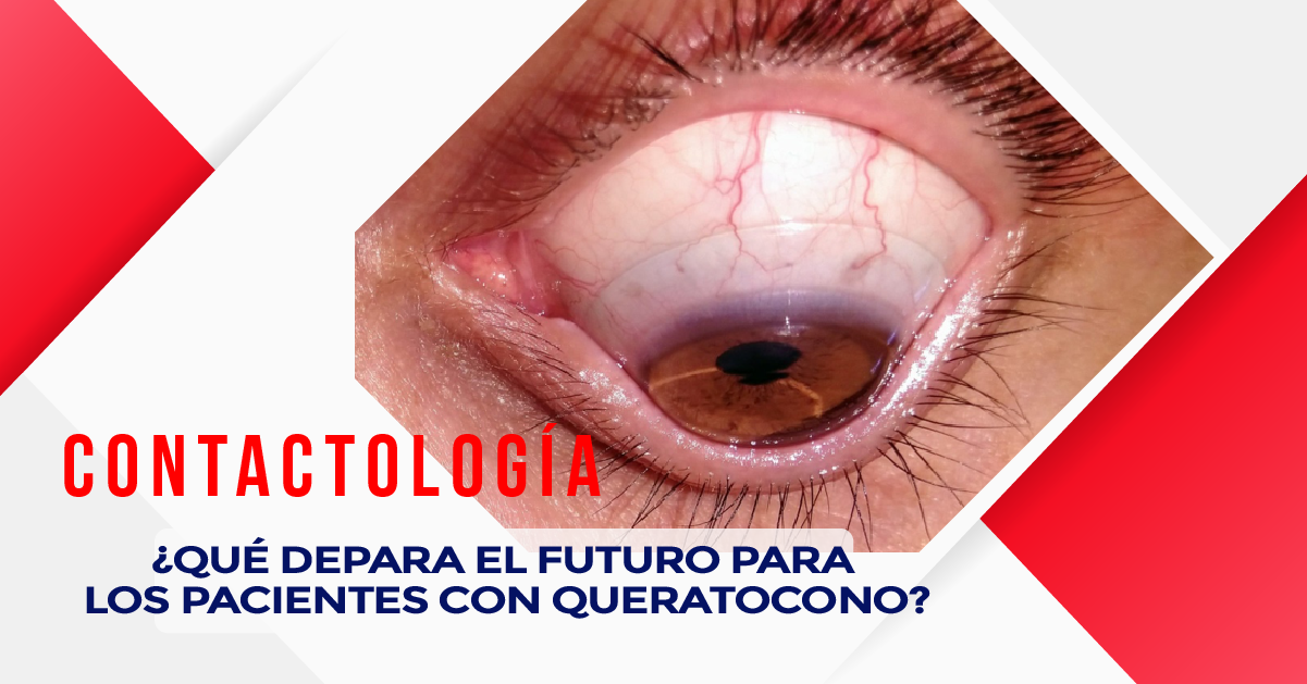 ¿QUÉ DEPARA EL FUTURO PARA LOS PACIENTES CON QUERATOCONO?