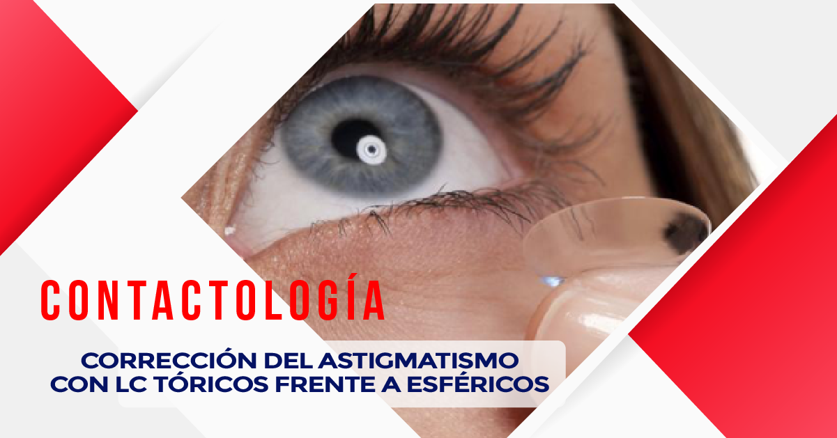 CORRECCIÓN DEL ASTIGMATISMO CON LC TÓRICOS FRENTE A ESFÉRICOS
