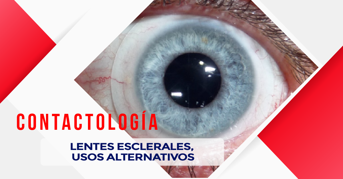 LENTES ESCLERALES, USOS ALTERNATIVOS