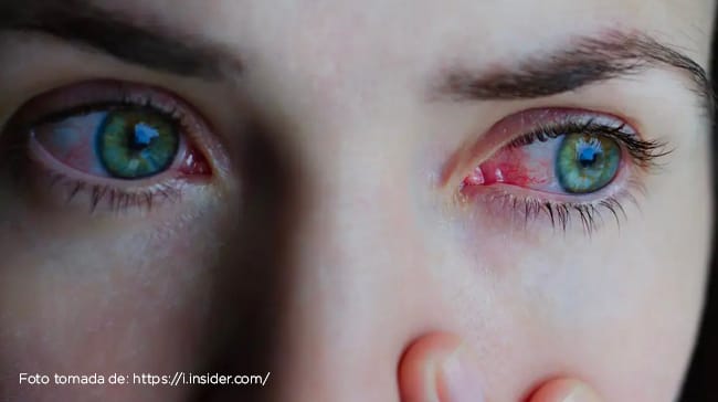 ¿QUÉ HAY DETRÁS DE TU OJO ROJO, PICOR, ARDOR?