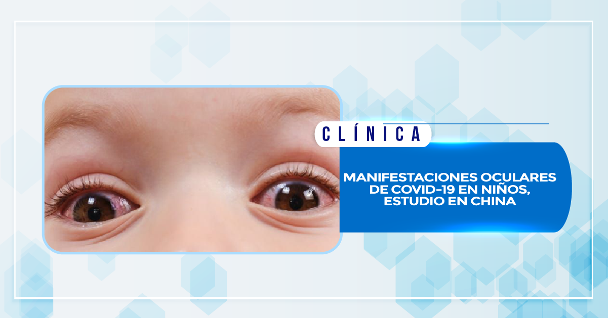 MANIFESTACIONES OCULARES DE COVID-19 EN NIÑOS, ESTUDIO EN CHINA