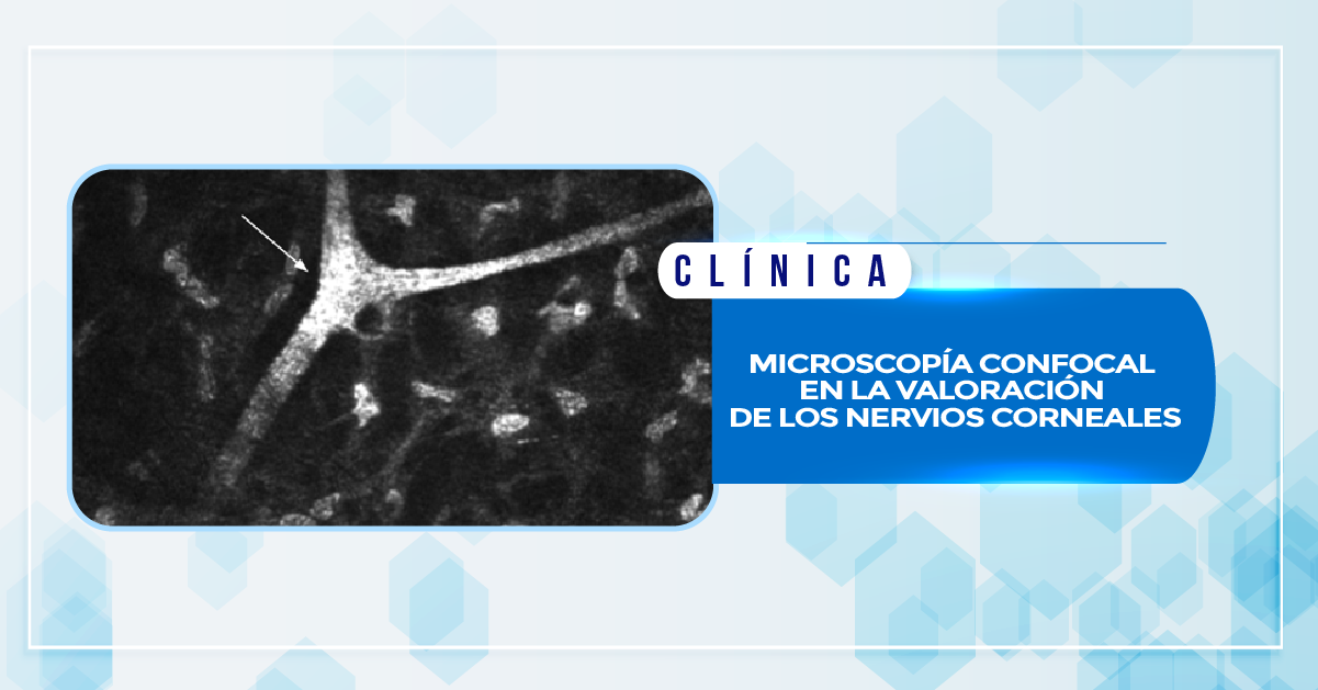 MICROSCOPÍA CONFOCAL EN LA VALORACIÓN DE LOS NERVIOS CORNEALES