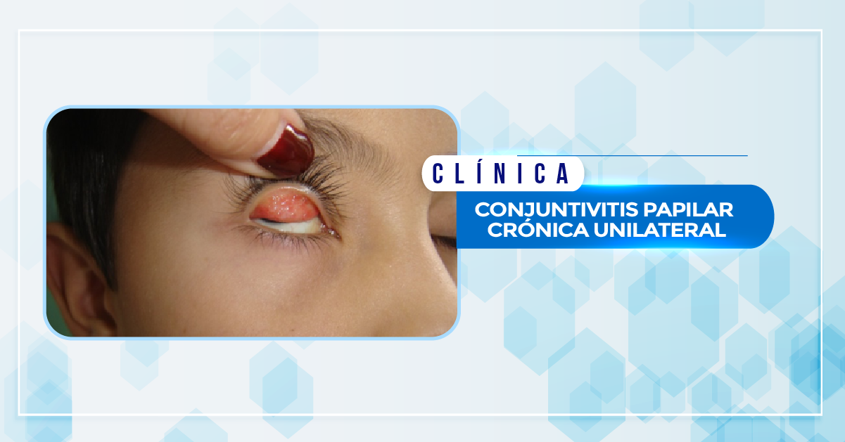 CONJUNTIVITIS PAPILAR CRÓNICA UNILATERAL