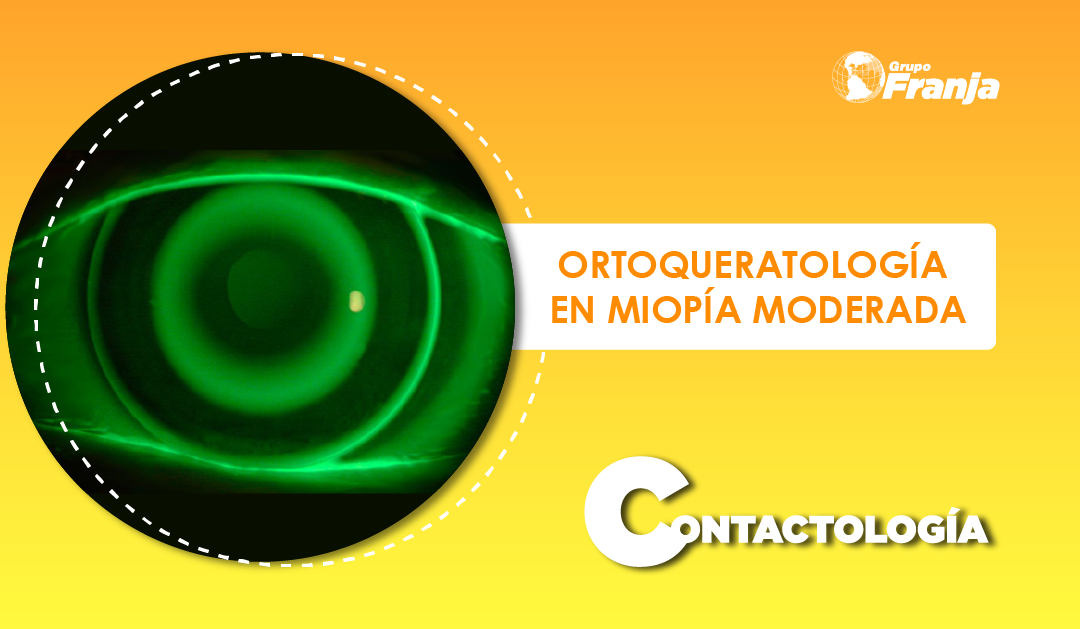 ORTOQUERATOLOGÍA EN MIOPÍA MODERADA
