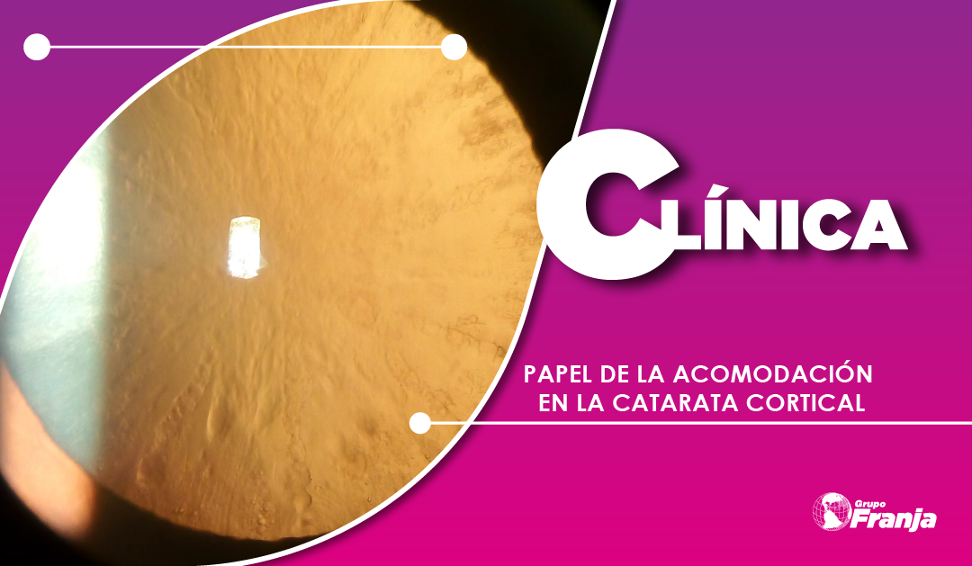PAPEL DE LA ACOMODACIÓN EN LA CATARATA CORTICAL