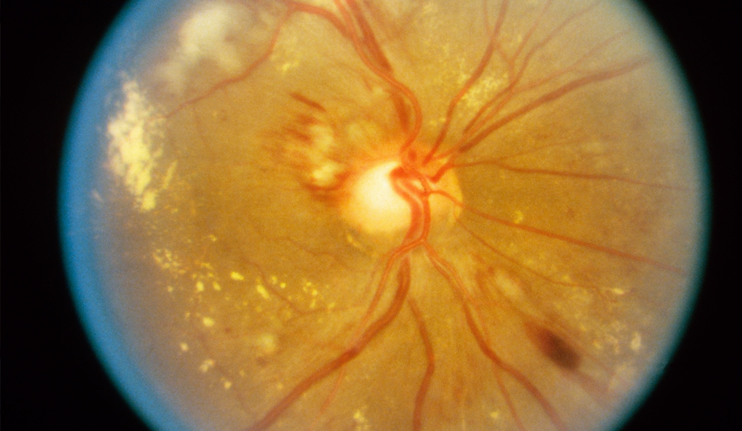 MANIFESTACIONES OCULARES DE LA ENFERMEDAD HIPERTENSIVA, PARTE I