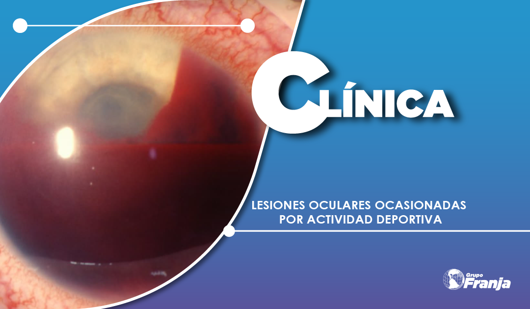 LESIONES OCULARES OCASIONADAS POR ACTIVIDAD DEPORTIVA