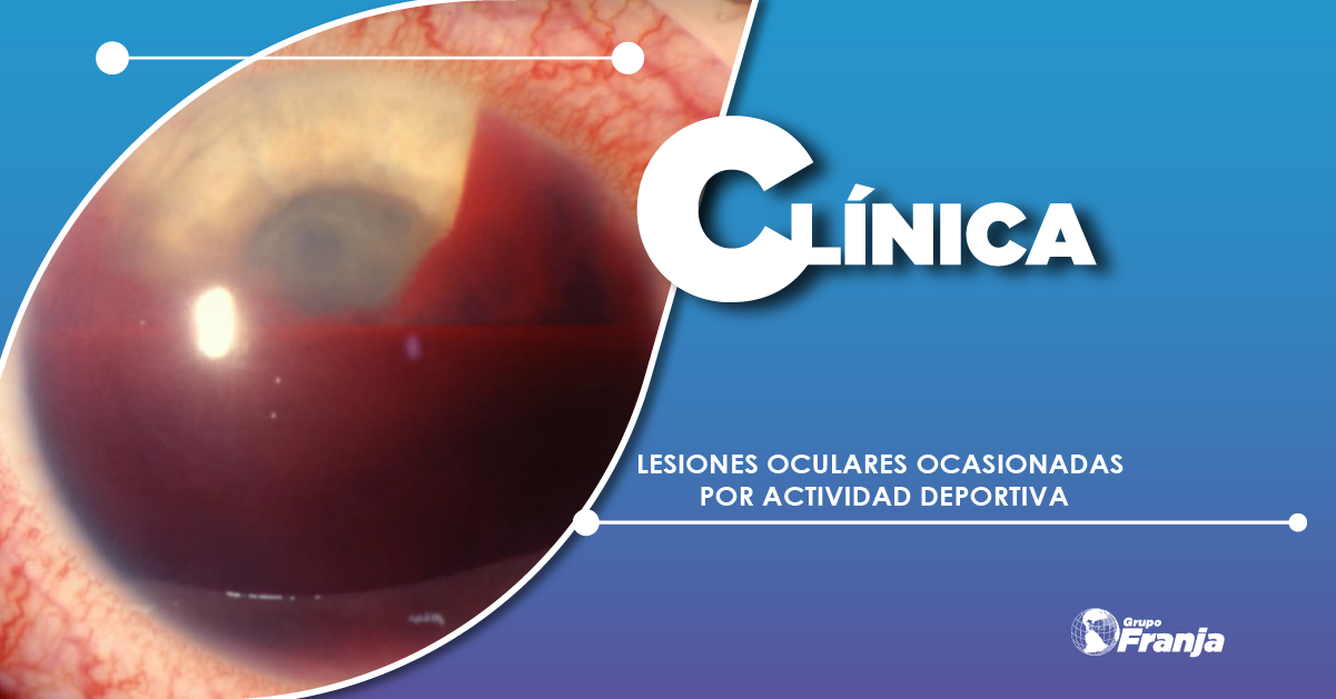 LESIONES OCULARES OCASIONADAS POR ACTIVIDAD DEPORTIVA