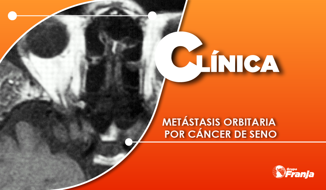 METÁSTASIS ORBITARIA POR CÁNCER DE SENO