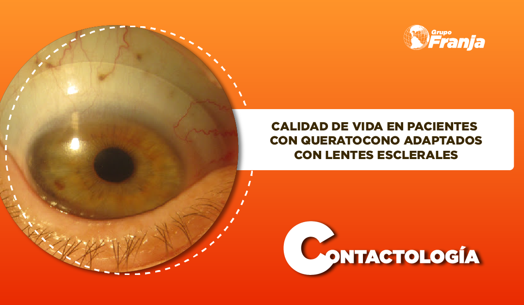 CALIDAD DE VIDA EN PACIENTES CON QUERATOCONO ADAPTADOS CON LENTES ESCLERALES