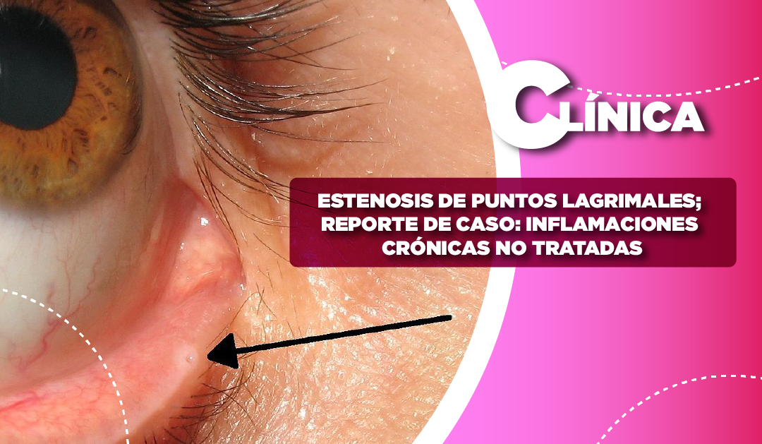 ESTENOSIS DE PUNTOS LAGRIMALES; REPORTE DE CASO: INFLAMACIONES CRÓNICAS NO TRATADAS