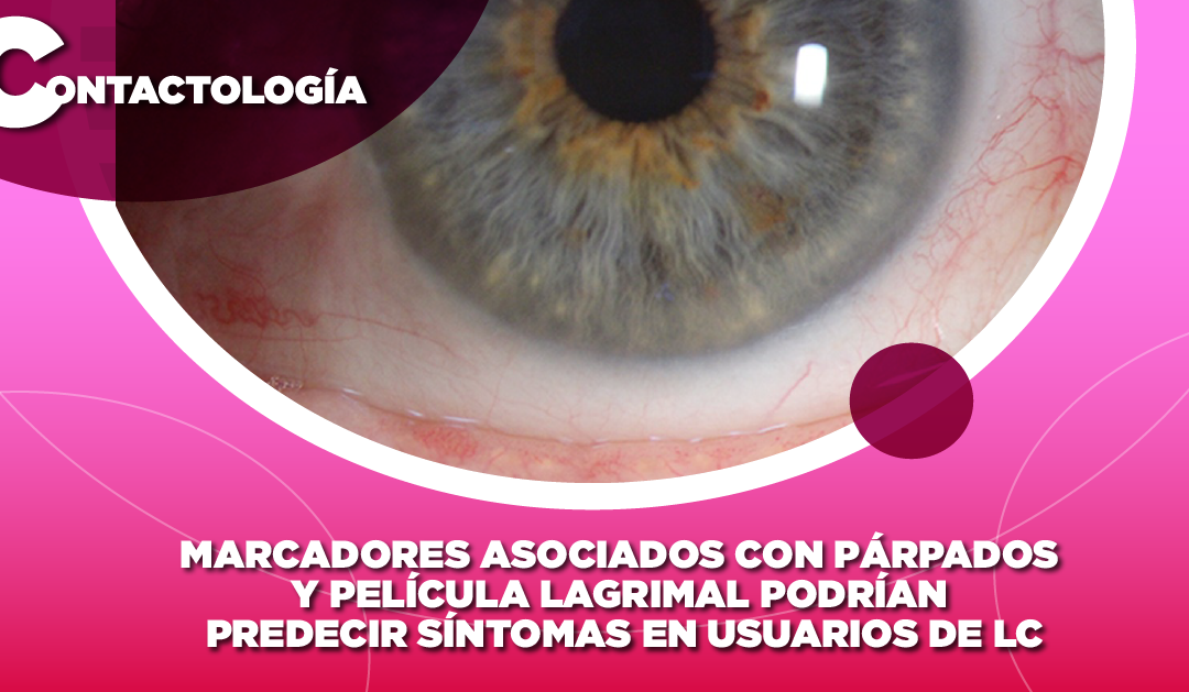 MARCADORES ASOCIADOS CON PÁRPADOS Y PELÍCULA LAGRIMAL PODRÍAN PREDECIR SÍNTOMAS EN USUARIOS DE LC