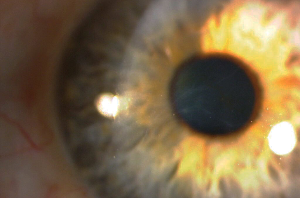 Lentes de contacto en el manejo de distrofias corneales