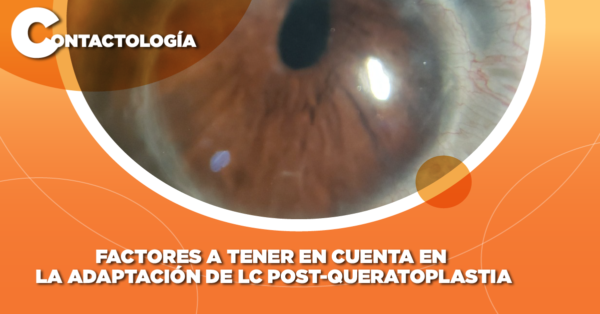 FACTORES A TENER EN CUENTA EN LA ADAPTACIÓN DE LC POST-QUERATOPLASTIA