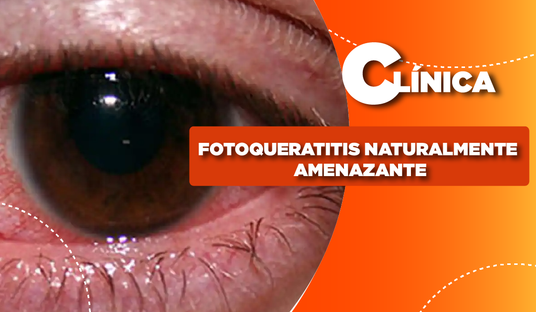 FOTOQUERATITIS NATURALMENTE AMENAZANTE