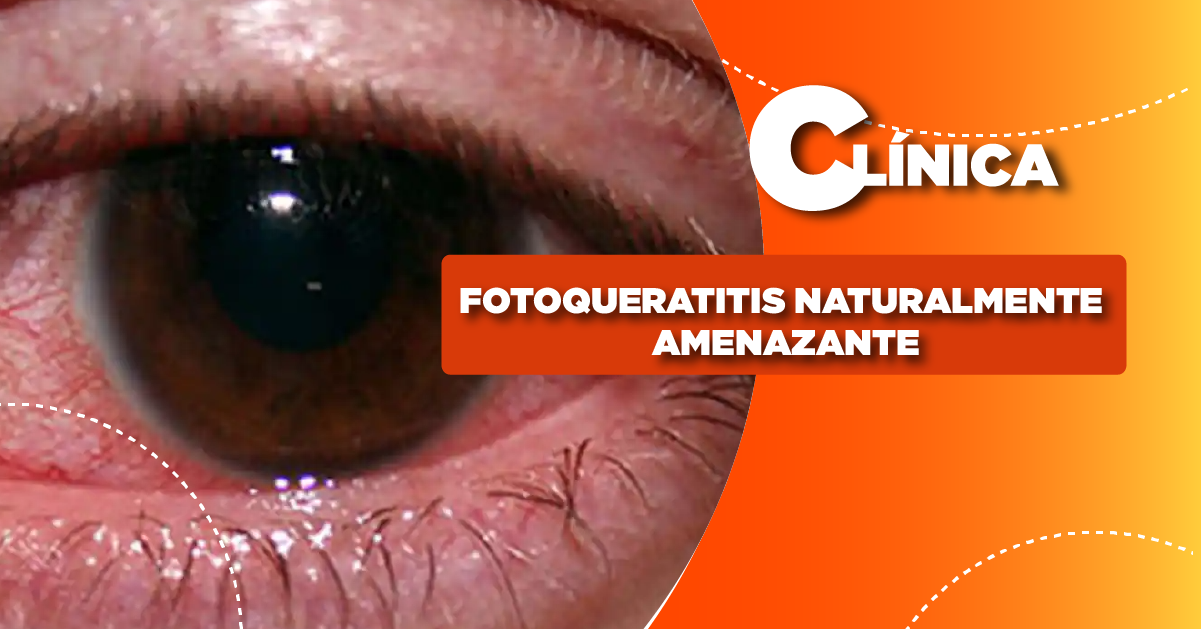 FOTOQUERATITIS NATURALMENTE AMENAZANTE
