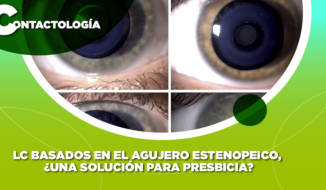 LC BASADOS EN EL AGUJERO ESTENOPEICO, ¿UNA SOLUCIÓN PARA PRESBICIA