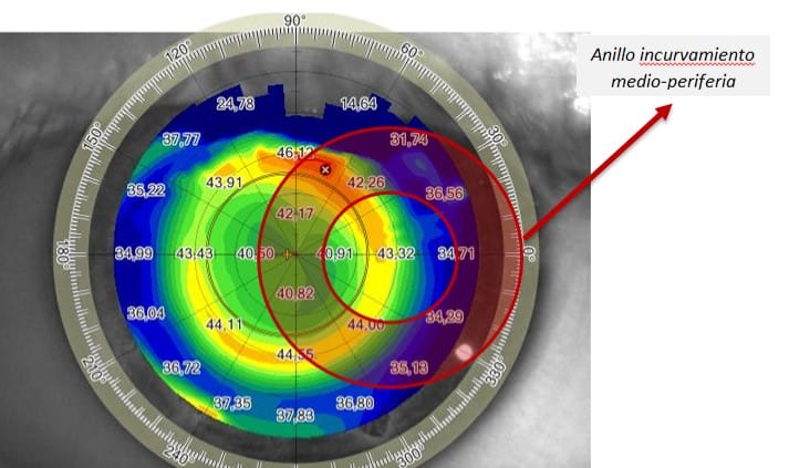 Figura 1. Mapa topográfico tangencial de un paciente miope tratado con ortoqueratología para la corrección de la miopía.