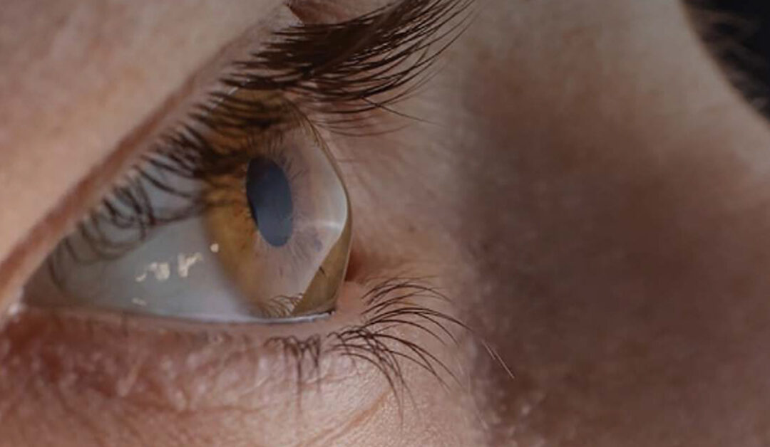 Cross linking acelerado,  ¿una opción más efectiva en  el tratamiento del queratocono?