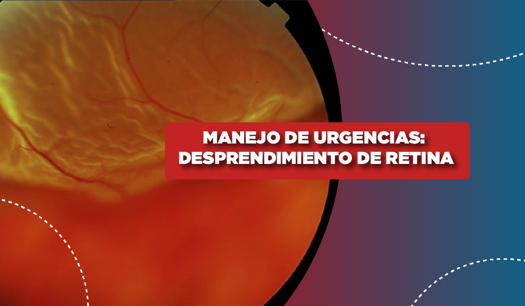 Manejo de urgencias: Desprendimiento de Retina