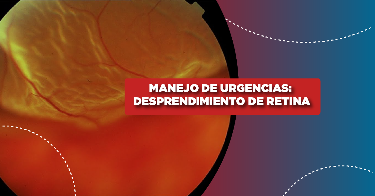 Manejo de urgencias: Desprendimiento de Retina