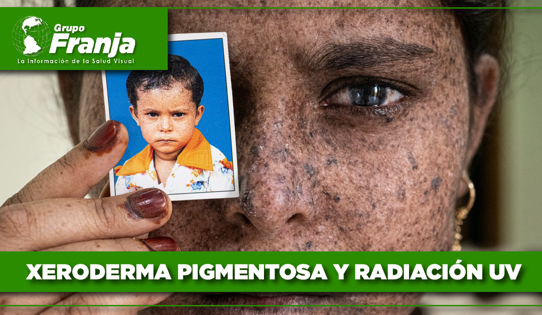 Xeroderma pigmentosa y radiación UV